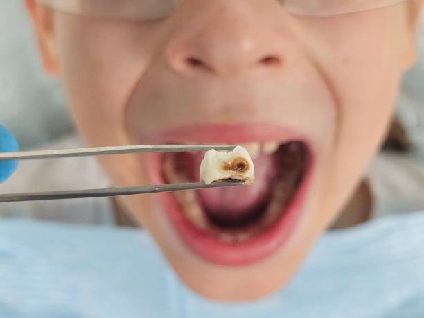 Best Emergency Wisdom Teeth Removal in Brookston, IN